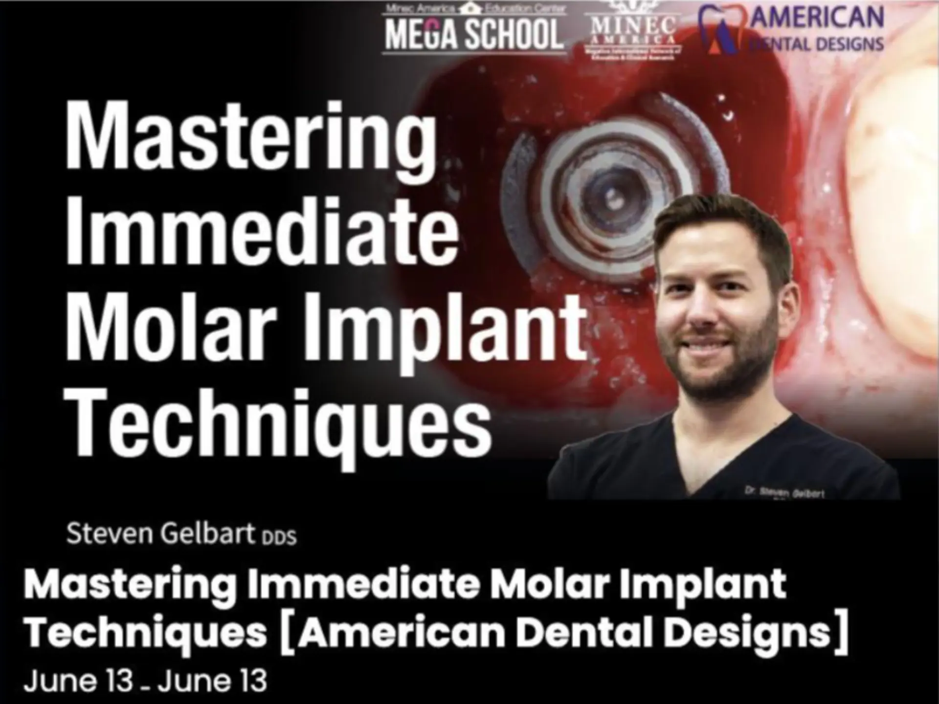Mastering Immediate Molar  Implant Techniques