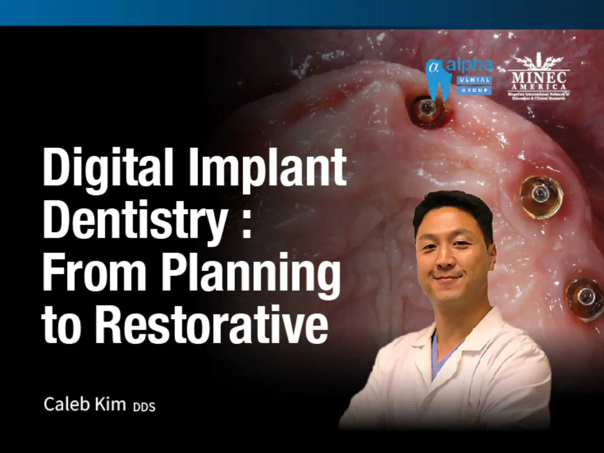 Digital Implant Dentistry: From Planning to Restorative